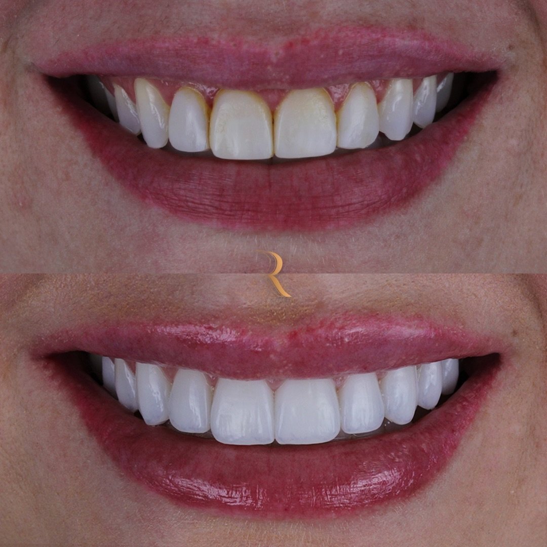 ANTES E DEPOIS 02