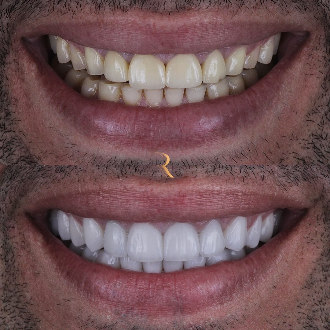ANTES E DEPOIS 03