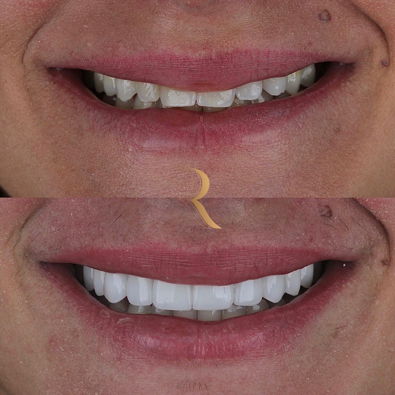 ANTES E DEPOIS 04