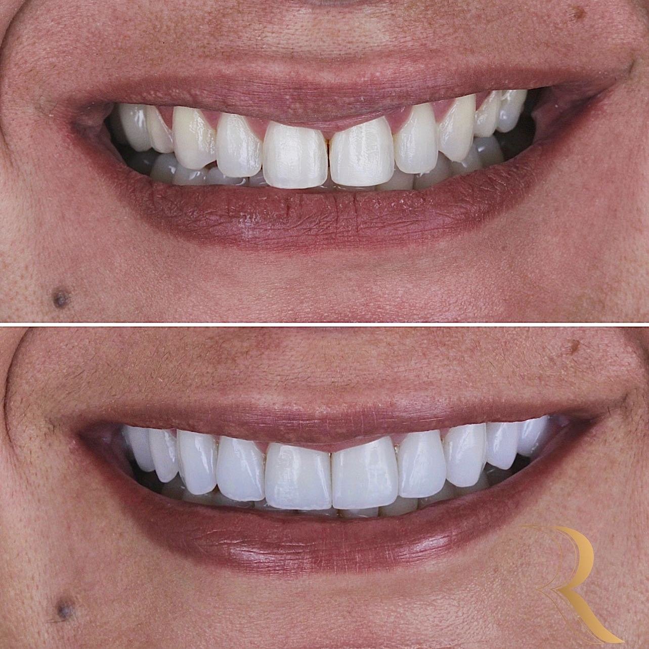 ANTES E DEPOIS 06