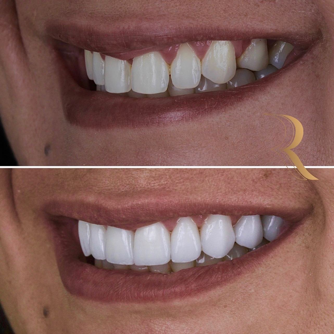 ANTES E DEPOIS 07