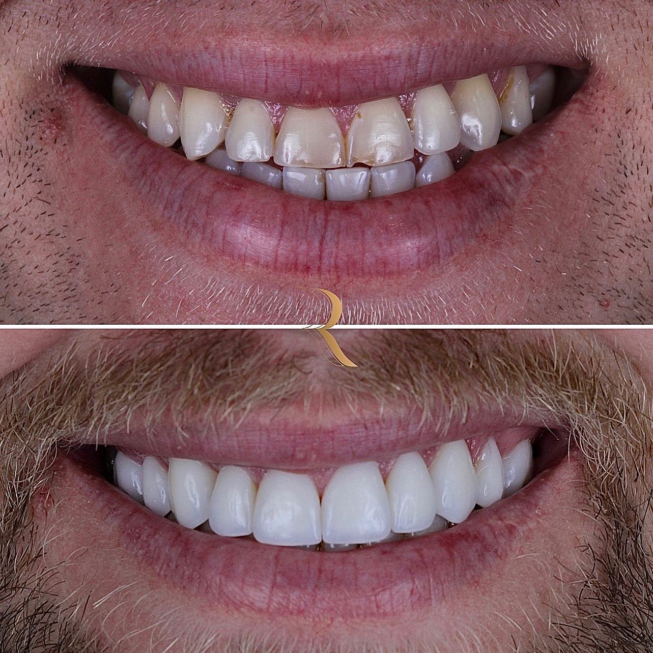 ANTES E DEPOIS 08