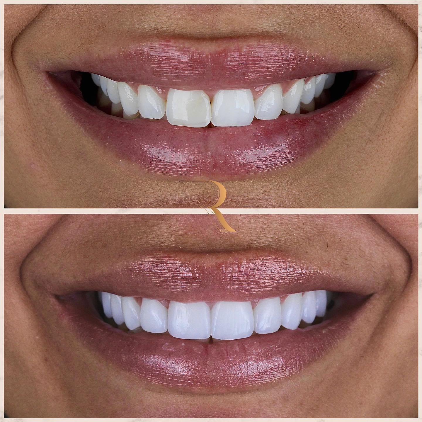 ANTES E DEPOIS 10