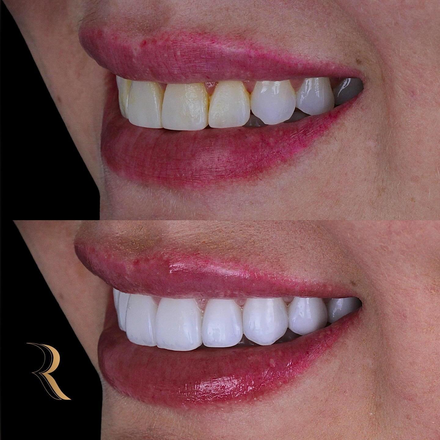 ANTES E DEPOIS 11