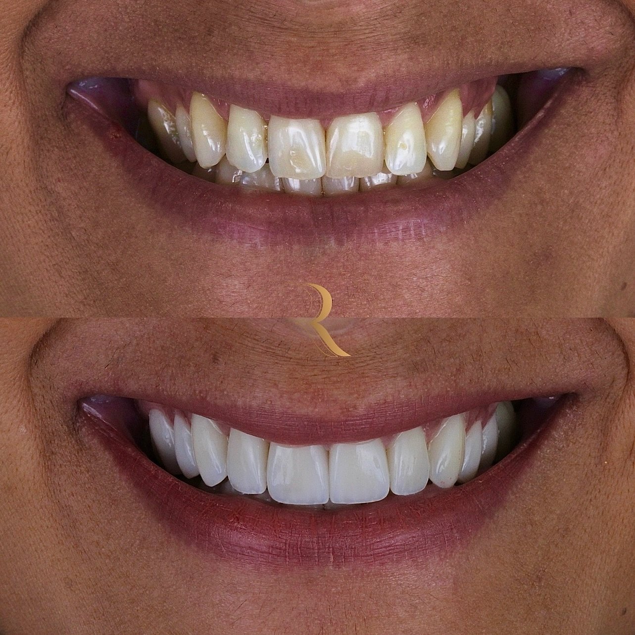 ANTES E DEPOIS 12